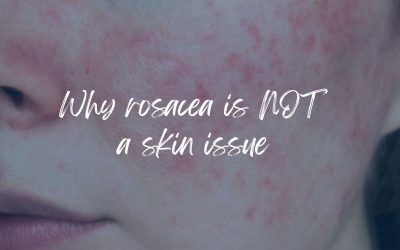 Why rosacea is NOT a skin issue