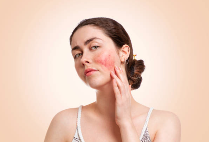 The Intricate Connection Between Liver Health and Rosacea The Intricate Connection Between Liver Health and Rosacea