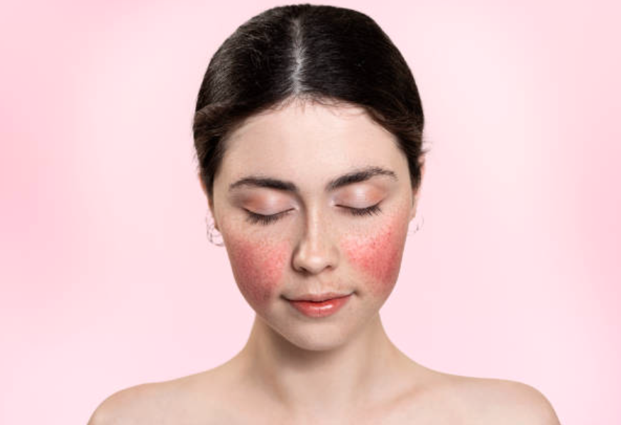 Exploring the Underlying Root Causes of Rosacea Exploring the Underlying Root Causes of Rosacea